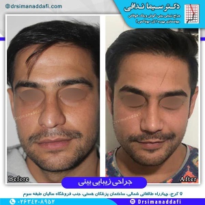جراحی-بینی-کرج-1