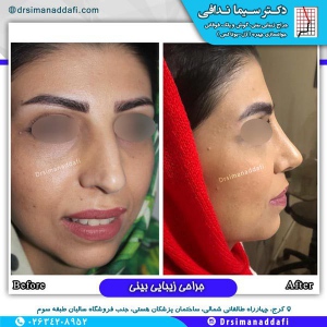 جراحی-بینی-کرج-100