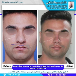 جراحی-بینی-کرج-102
