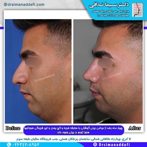 جراحی-بینی-کرج-103