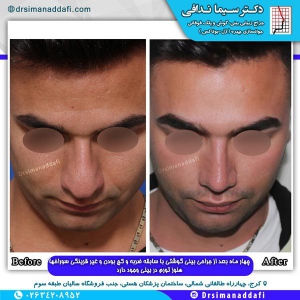 جراحی-بینی-کرج-105
