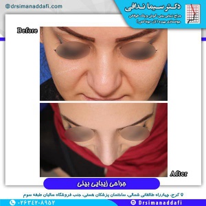 جراحی-بینی-کرج-11