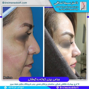 جراحی-بینی-کرج-114