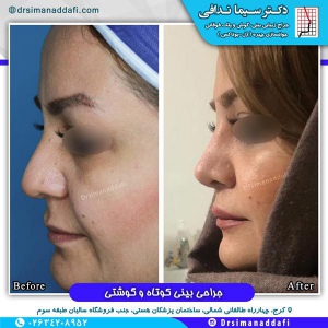 جراحی-بینی-کرج-12