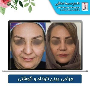 جراحی-بینی-کرج-13