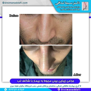 جراحی-بینی-کرج-15