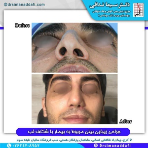جراحی-بینی-کرج-16
