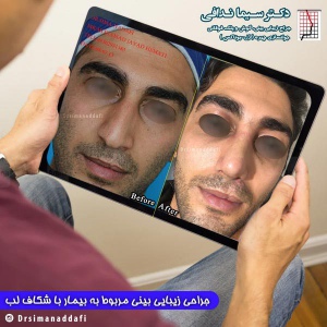 جراحی-بینی-کرج-17