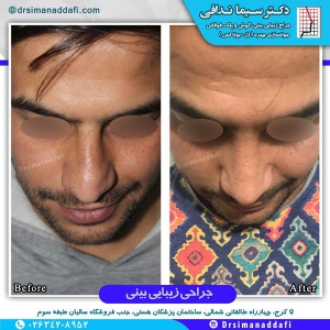 جراحی-بینی-کرج-2