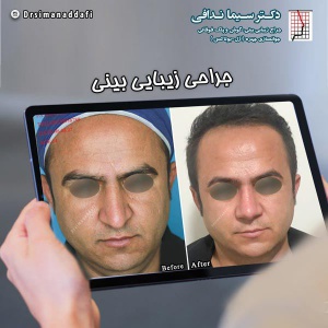جراحی-بینی-کرج-20