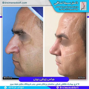 جراحی-بینی-کرج-21
