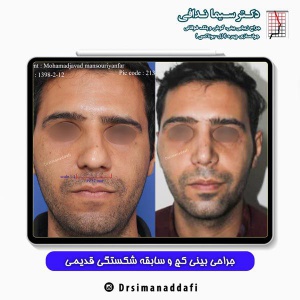 جراحی-بینی-کرج-22