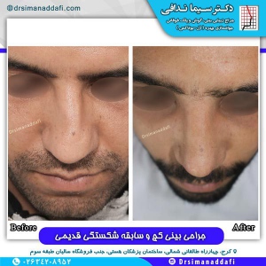 جراحی-بینی-کرج-23
