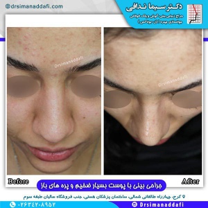 جراحی-بینی-کرج-25