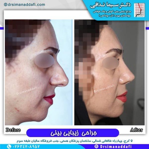 جراحی-بینی-کرج-30
