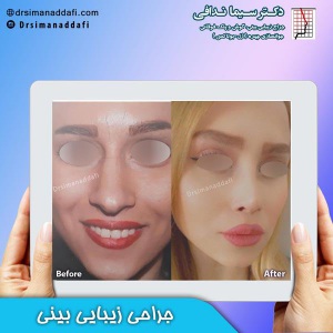 جراحی-بینی-کرج-31