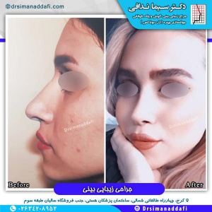 جراحی-بینی-کرج-35