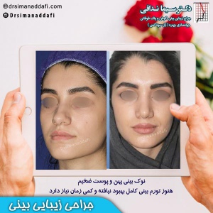 جراحی-بینی-کرج-36