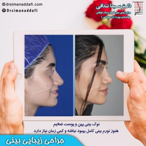 جراحی-بینی-کرج-37