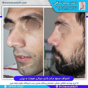 جراحی-بینی-کرج-39