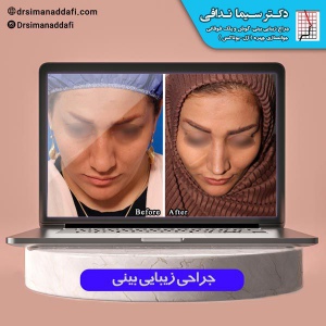 جراحی-بینی-کرج-4