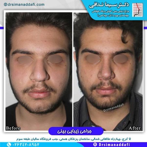 جراحی-بینی-کرج-40