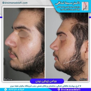 جراحی-بینی-کرج-41