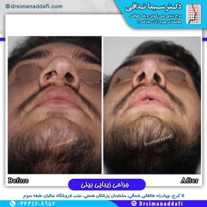 جراحی-بینی-کرج-42