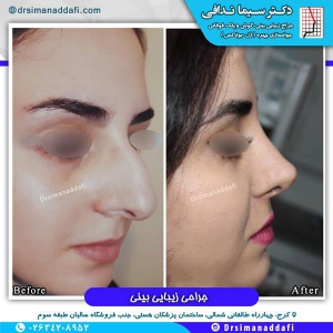 جراحی-بینی-کرج-43