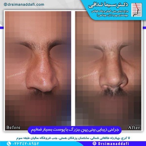 جراحی-بینی-کرج-5