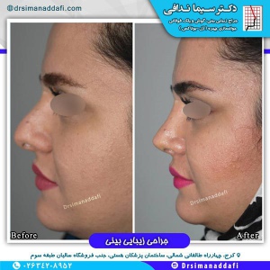جراحی-بینی-کرج-50