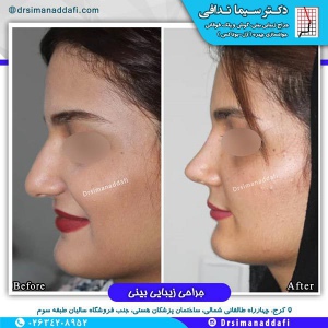 جراحی-بینی-کرج-51
