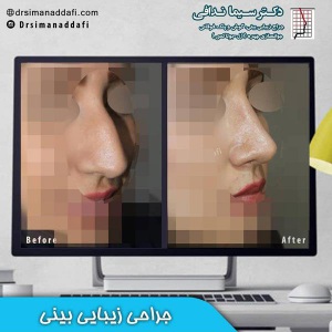 جراحی-بینی-کرج-52