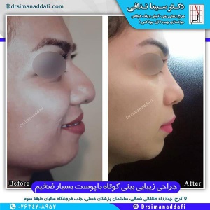 جراحی-بینی-کرج-54