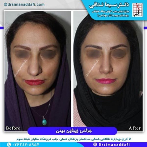 جراحی-بینی-کرج-55