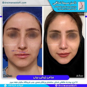 جراحی-بینی-کرج-57