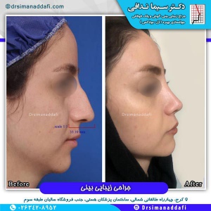 جراحی-بینی-کرج-58