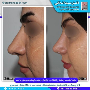 جراحی-بینی-کرج-6