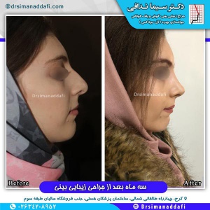 جراحی-بینی-کرج-60
