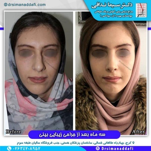 جراحی-بینی-کرج-62