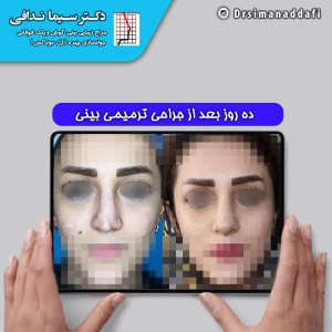 جراحی-بینی-کرج-64