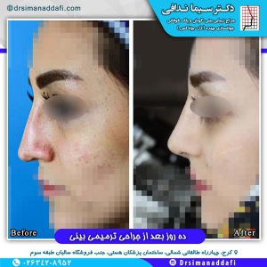 جراحی-بینی-کرج-65