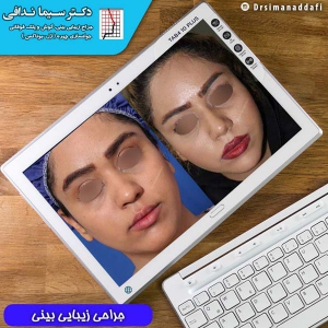 جراحی-بینی-کرج-68