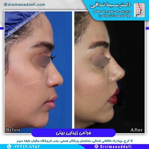 جراحی-بینی-کرج-69