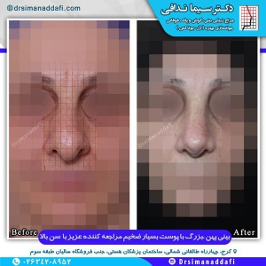جراحی-بینی-کرج-7