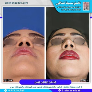 جراحی-بینی-کرج-70