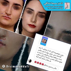 جراحی-بینی-کرج-71