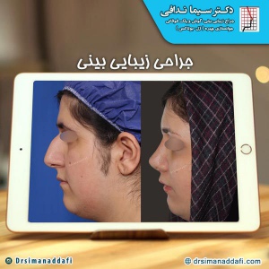 جراحی-بینی-کرج-72