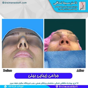 جراحی-بینی-کرج-73