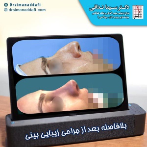جراحی-بینی-کرج-74